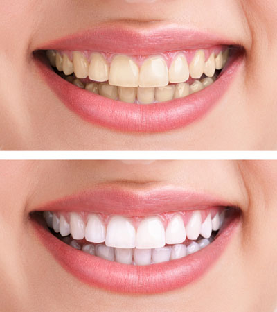Teeth whitening from Rotherham dentist